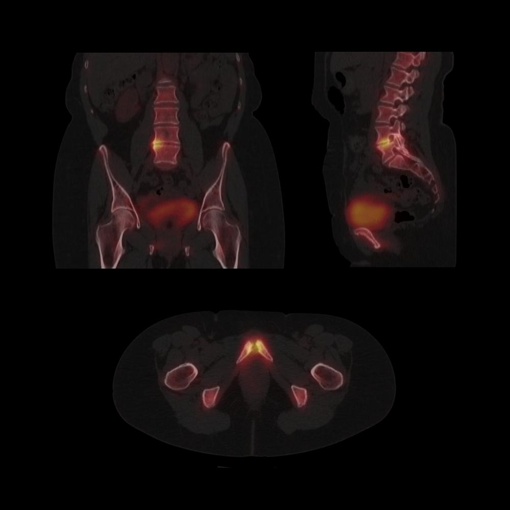 SPECT/CT aids in the detection of vertebral and pelvic degenerative and inflammatory skeletal pathology