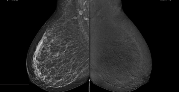 Right breast_2