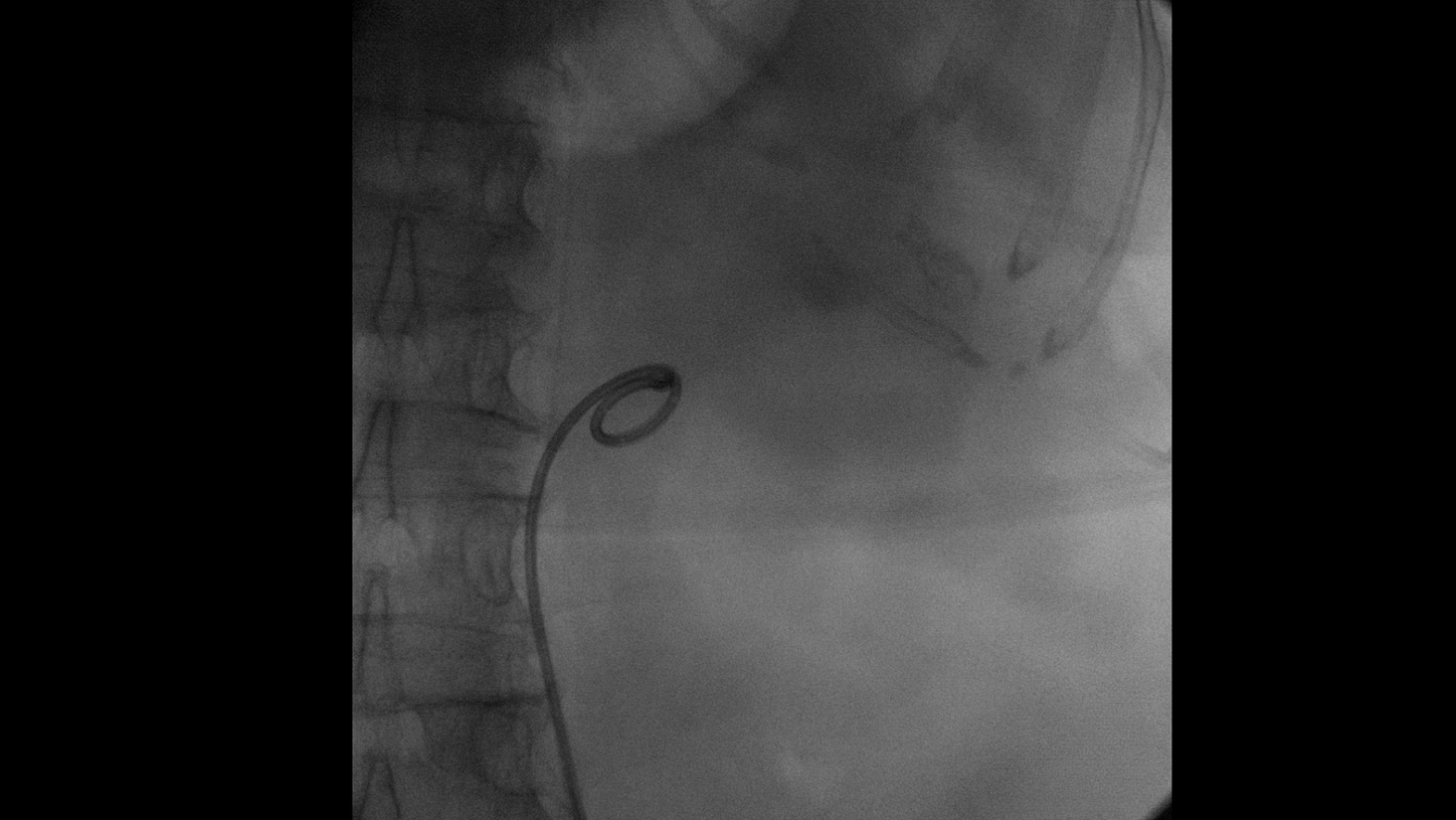 Urology catheter with Cios Fit, a mobile 2D C-arm for surgery.
