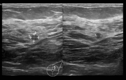 Image G: Image from a previous scan performed outside the facility, where no elastography  was conducted.