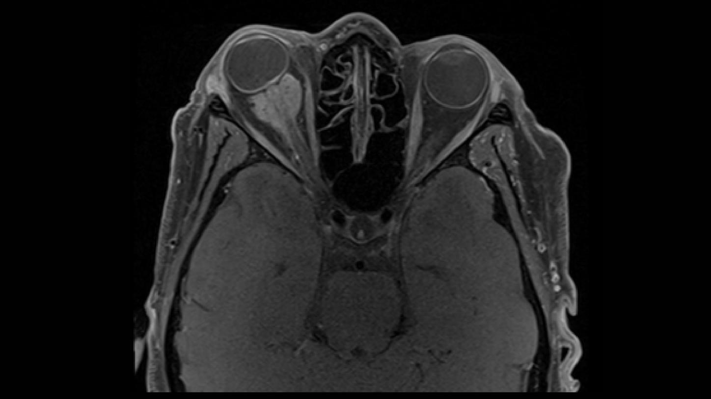 CT image of retro-ocular masses causing exophthalmos along with bilateral perinephric, pericardial, and pelvic exudates