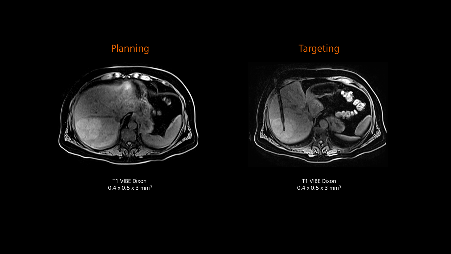 Liver biopsy: focal nodular hyperplasia (MAGNETOM Free.Max)