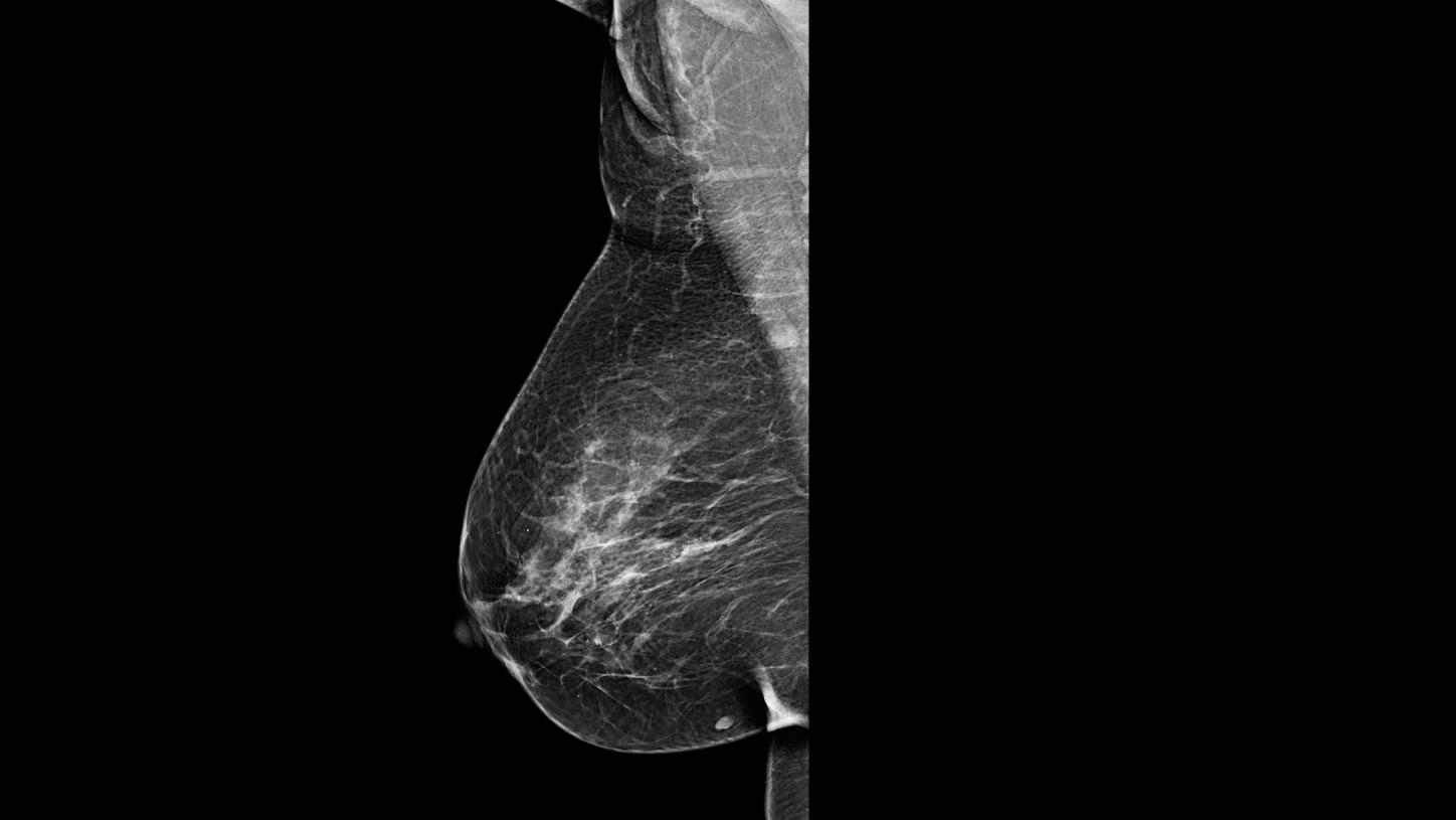 mamografia de rastreio