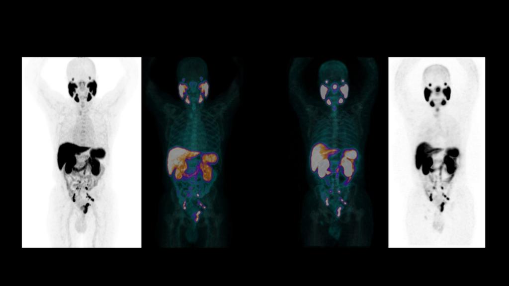 A comparative analysis of 99mTc-iPSMA SPECT/CT and 18F-PSMA-1007 PET/CT