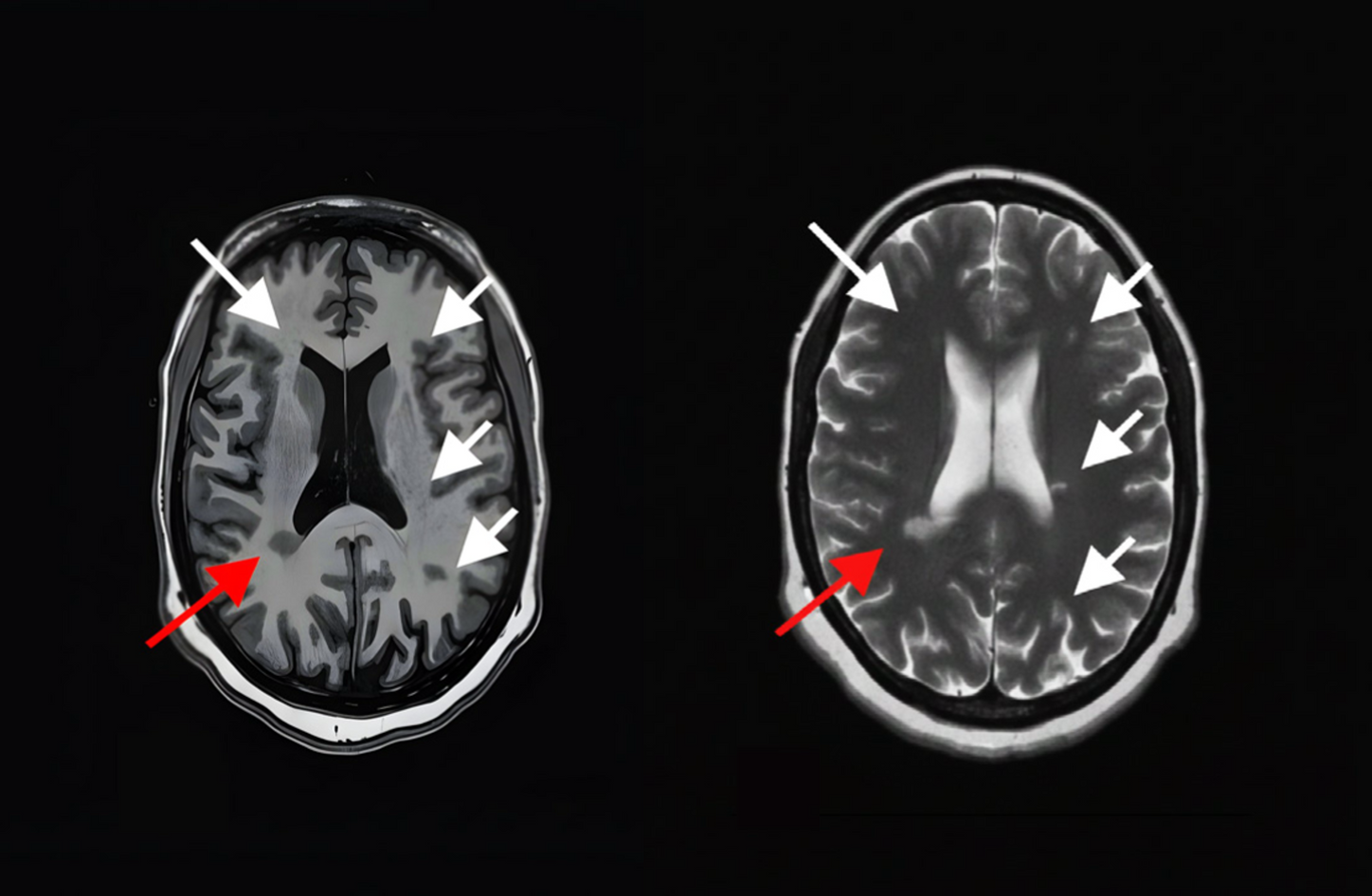 Figure A & B - MRI