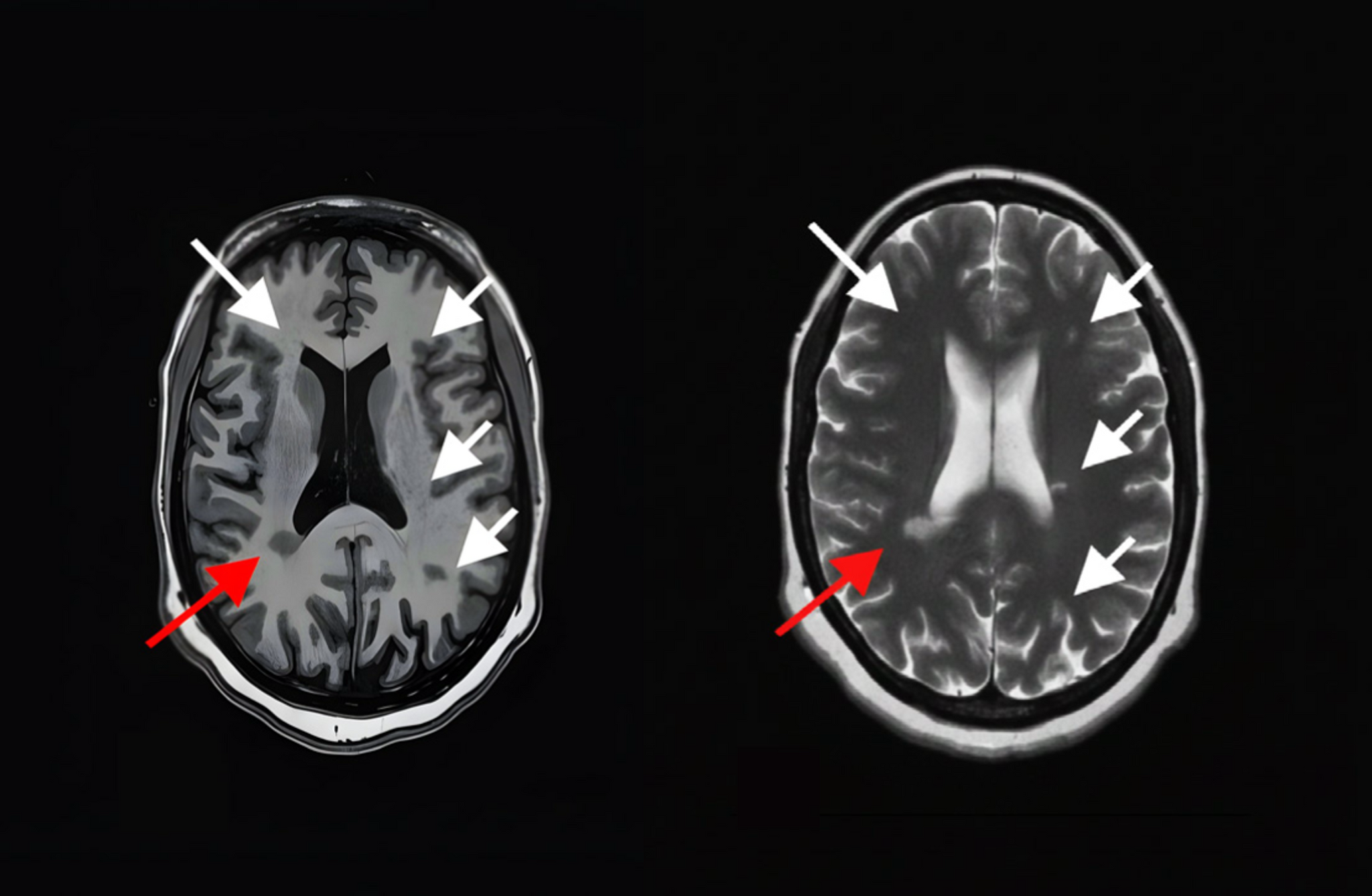 Advanced Multiparametric MRI for decoding smoldering Multiple Sclerosis ...