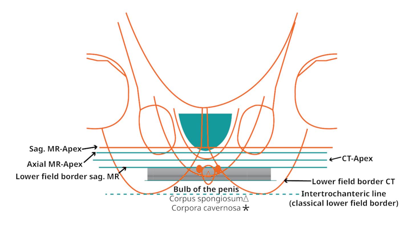A diagram shows that the prostatic apex is located 29 mm above a reference line on sagittal MRI, helping to spare healthy tissue. Axial MRI places the apex 2 mm lower, and CT places it 5 mm lower than sagittal MRI (adapted from Wachter et al.5 Copyright 2022 Springer Medicine).