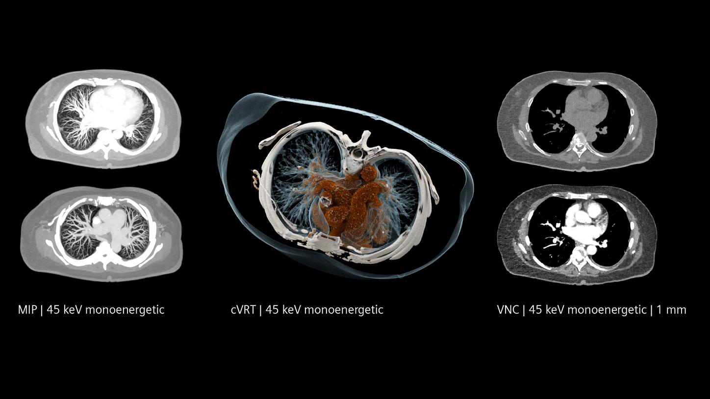 MIP, cVRT, VNC, all 45 keV: Incidental finding case of CTEPH in tumor localizer exam, Quantum Spectral imaging reveals perfusion defects