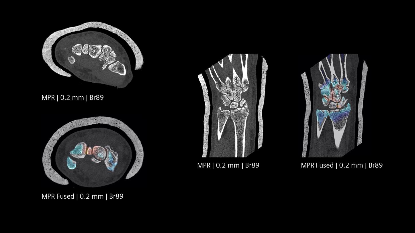 Bone marrow evaluation of wrist in a cast with Quantum HD