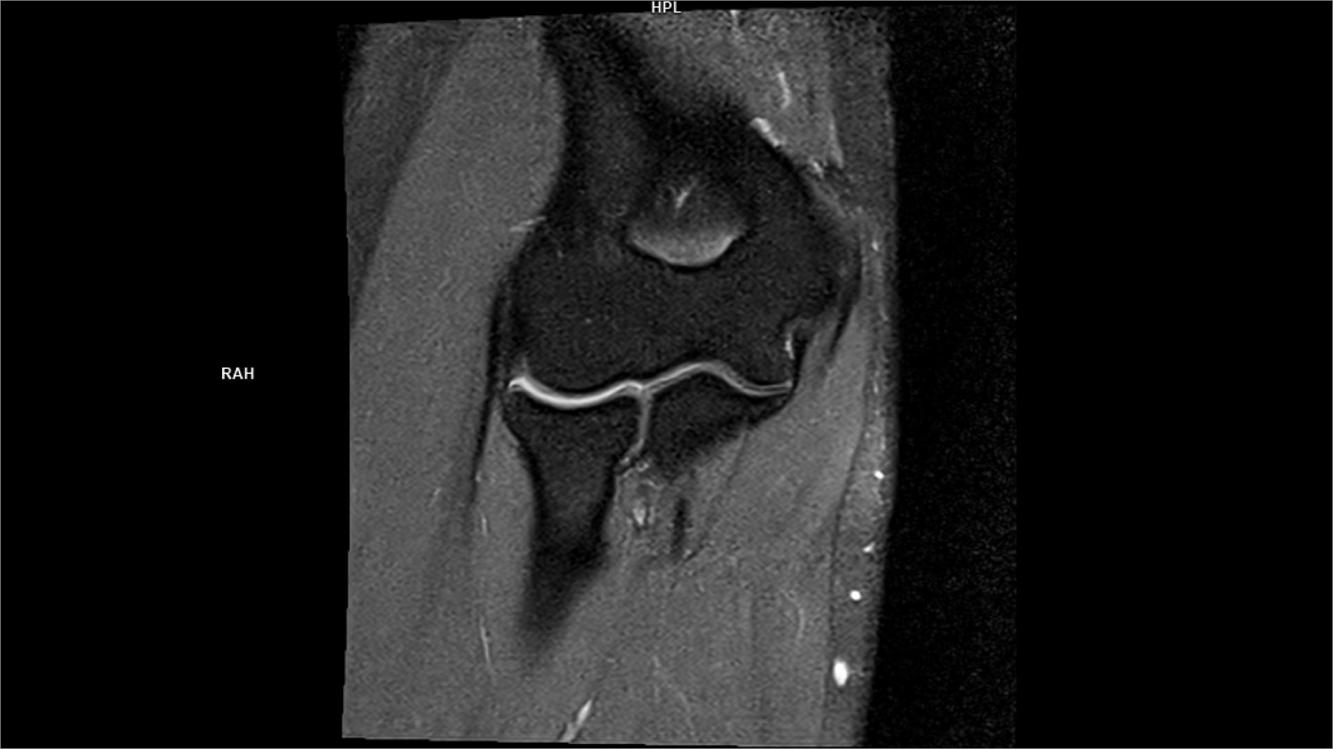 Coronal PD Free.Max Siemens Healthineers USA
