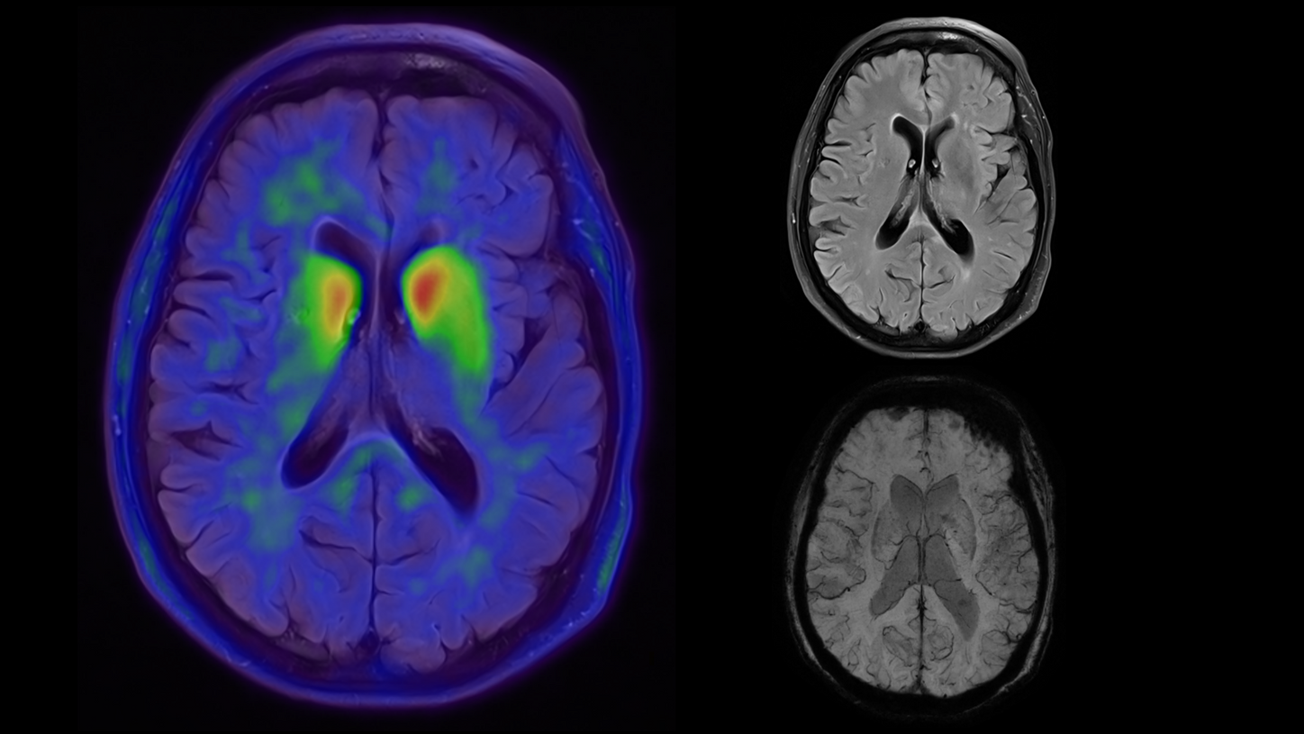 siemens-healthineers_DI-MR_BIOGRAPH-One_parkinsons_disease