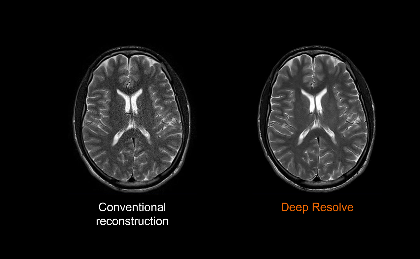 Comparison between conventional reconstruction and Deep Resolve