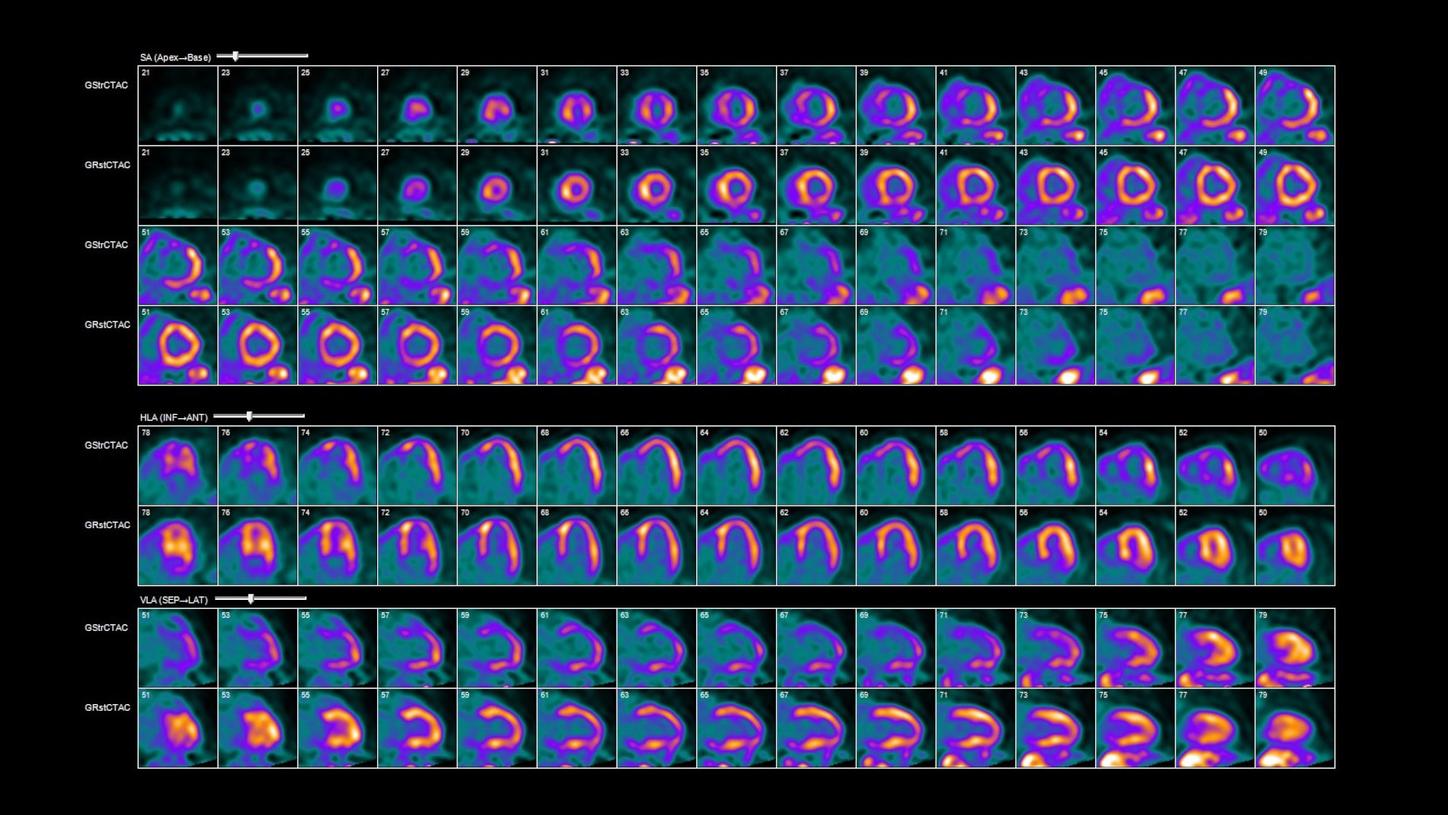 PET stress cardiac gated (top) and PET rest cardiac gated (bottom).