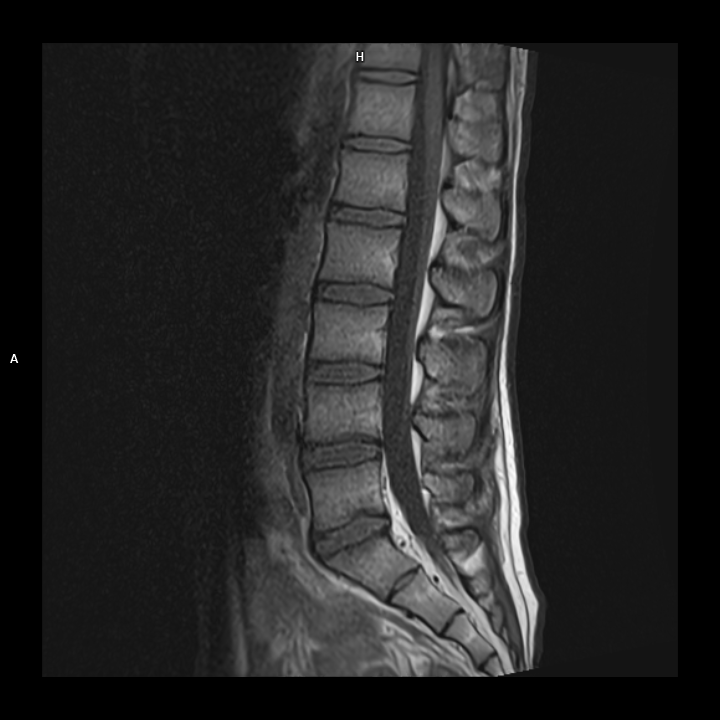 Sagittal T1-MAGNETOM Free.Max/Coil-Spine/Resolution-512/Scan Time-2:48/Aceleration-p2 DRS