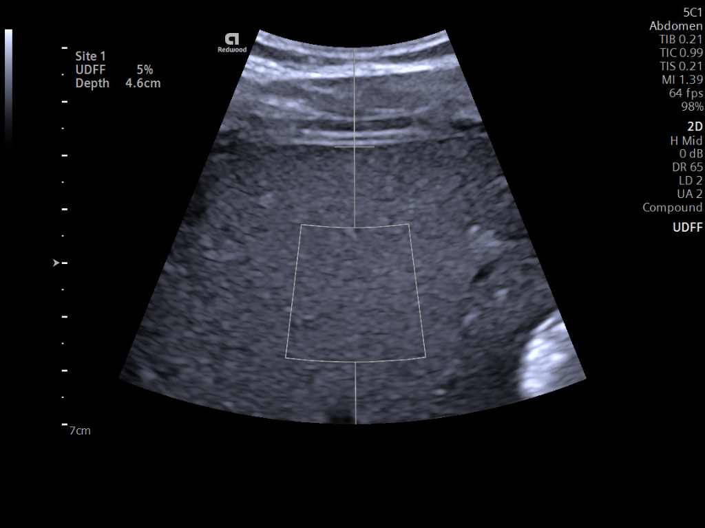 Ultrasound-derived fat fraction