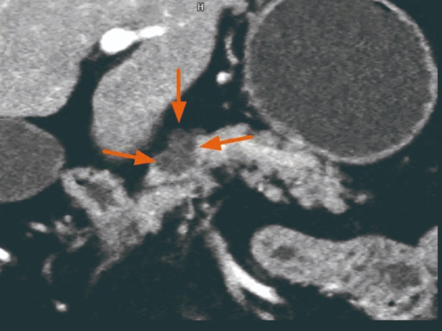 NAEOTOM Alpha.Prime 膵臓の評価