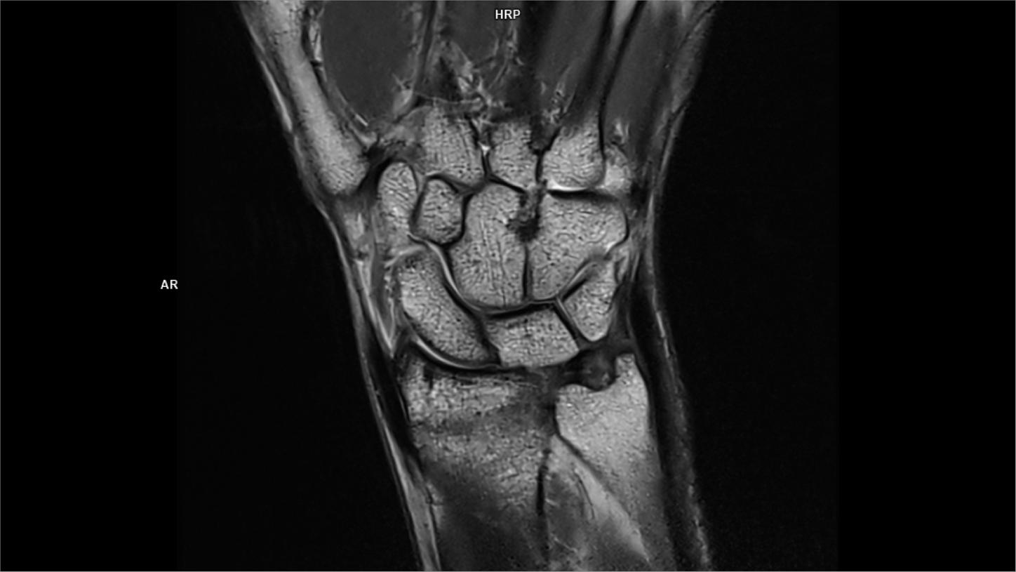 Coronal PD tse DR Vida