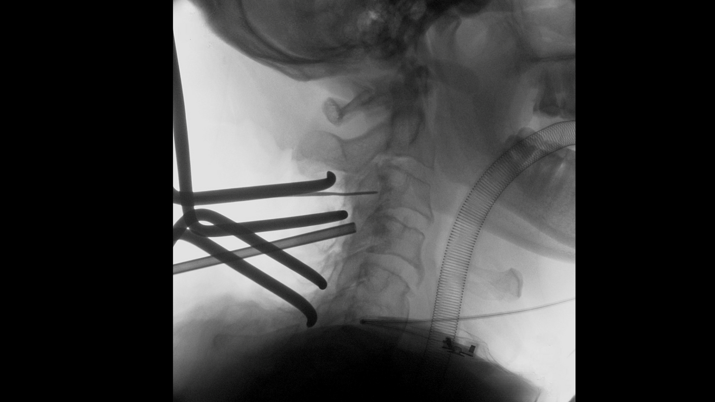 Cervical spine surgery with Cios Fit, a mobile 2D C-arm for surgery.