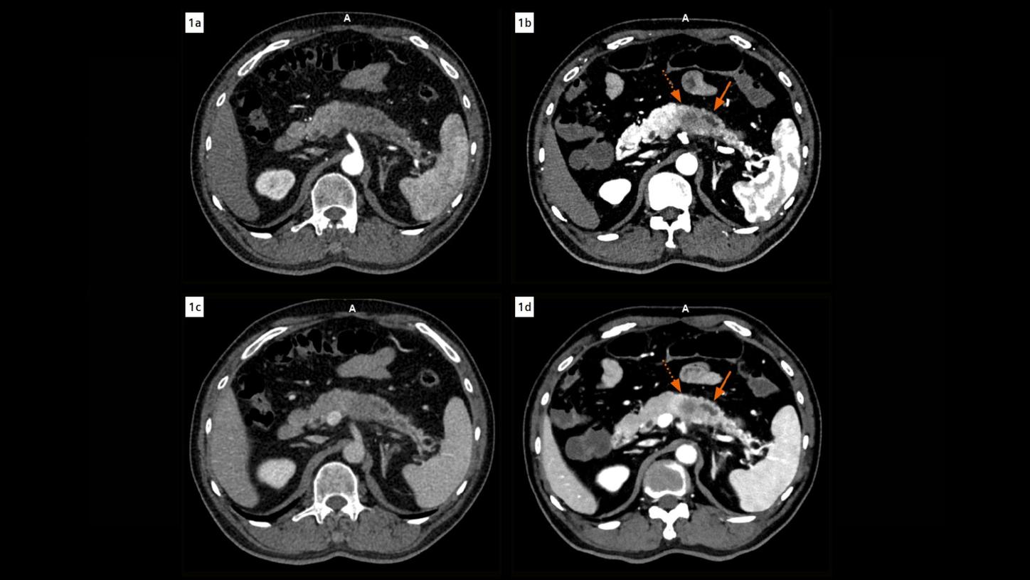 Axial images acquired during the arterial and venous phases show a comparison of CT findings in the pancreas in EID and PCD CT images. The arterial images are at 1 mm for the EID and at 0.4 mm for the PCD. Venous images are at 3 mm for both. The fluid attenuation within the main pancreatic duct adjacent to the tumor appears heterogeneous in EID CT images, however, clearly homogeneous in PCD CT images, ruling out the suspicion of an intraductal tumor spread. The tumor is distinctly delineated with clear margins in the PCD CT images. Note the improved contrast in PCD CT images using VMIs displayed at 50 keV
