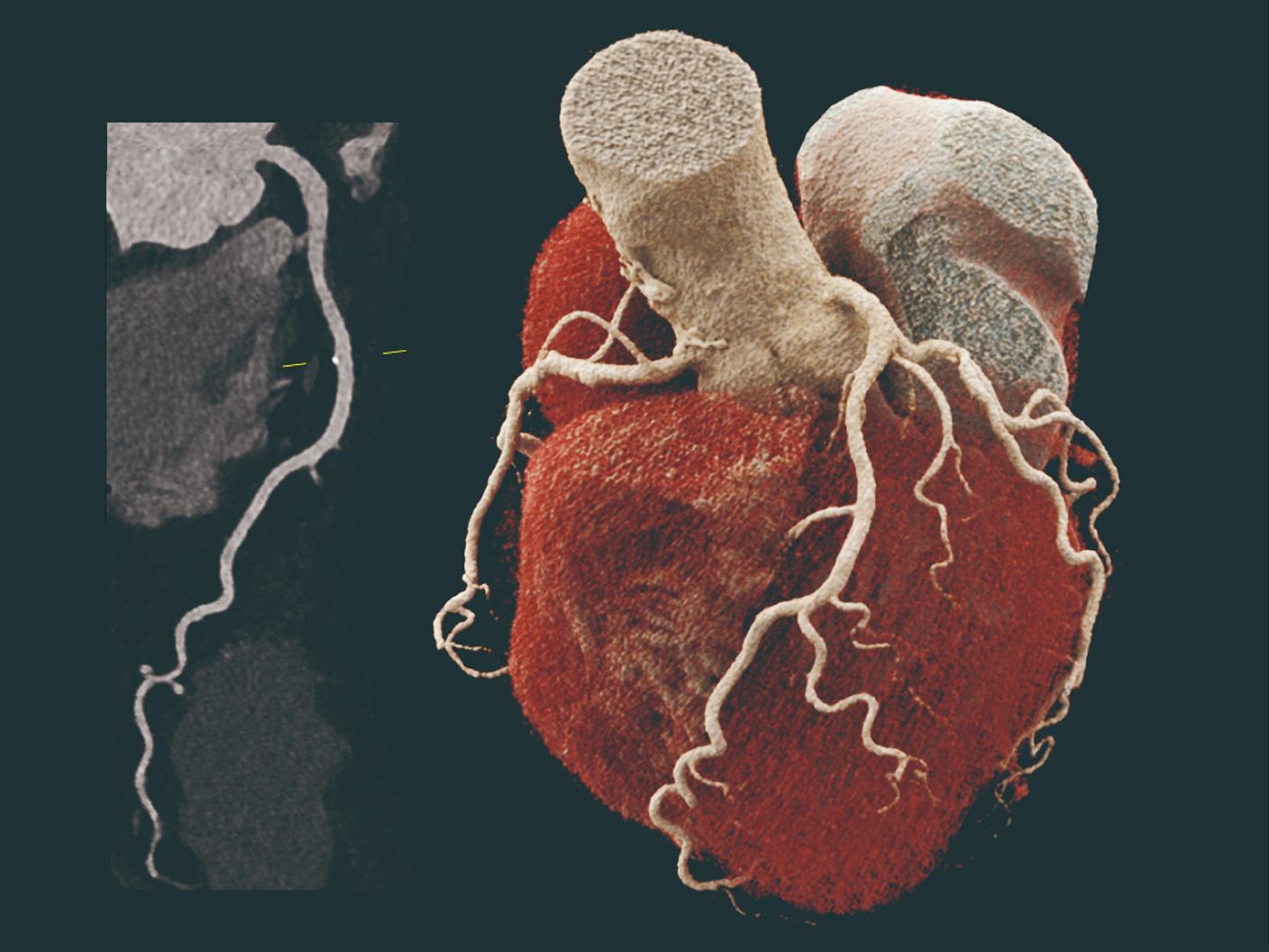 NAEOTOM Alpha class冠動脈評価