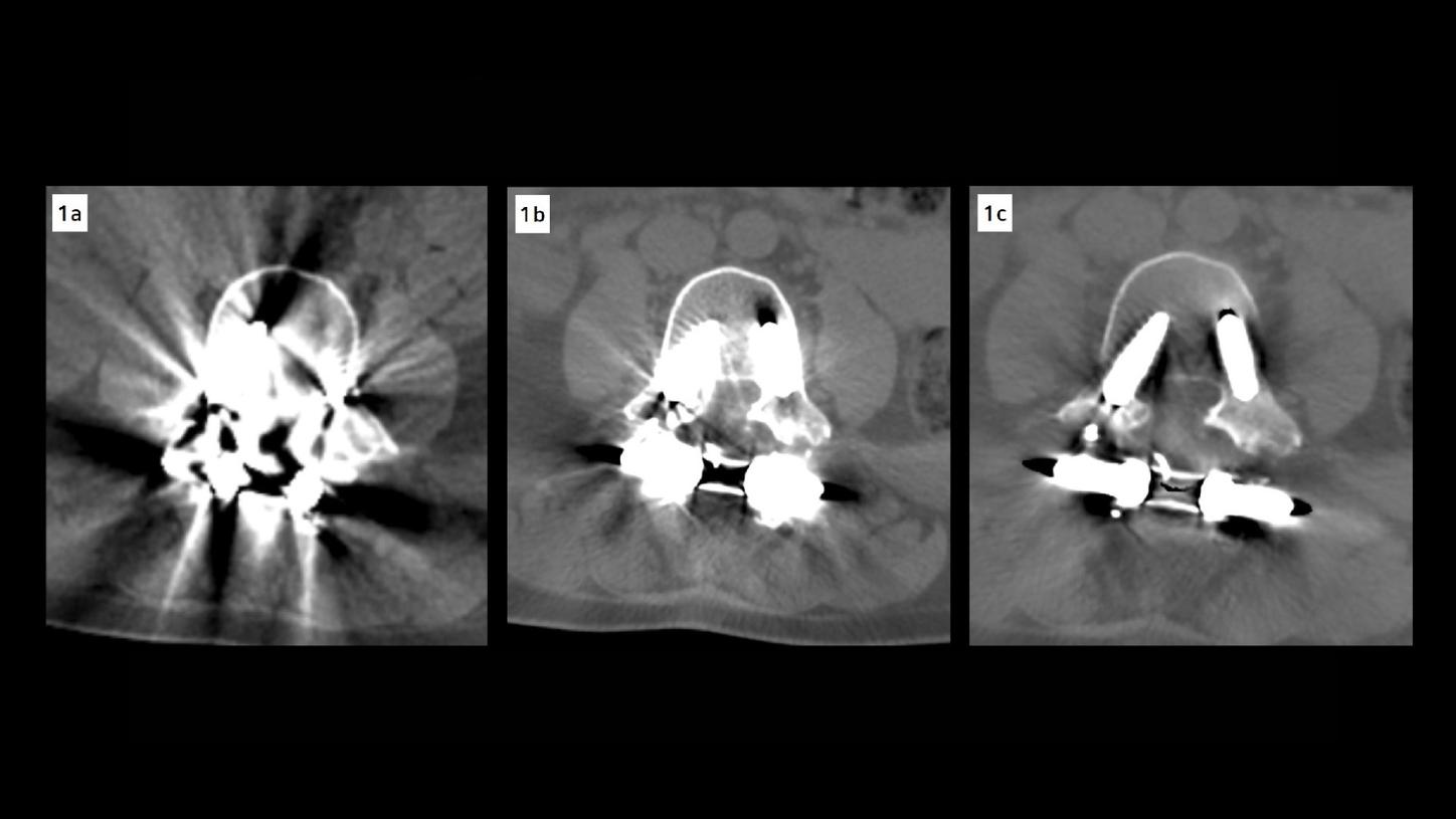 Three axial CT images of the lumbar spine at the L3–L4 discal space. An image acquired on a previous standard multislice CT scanner, shows prominent metal artifacts that obscure the vertebral anatomy and prosthetic components. An image reconstructed using iterative metal artifact reduction at 120 kV, demonstrates improved delineation of bone structures and reduction of streak artifacts. An image reconstructed with iterative metal artifact reduction combined with high-energy monoenergetic imaging at 140 keV, provides superior image quality with markedly reduced metal artifacts and enhanced visualization of the prosthesis and surrounding anatomy.