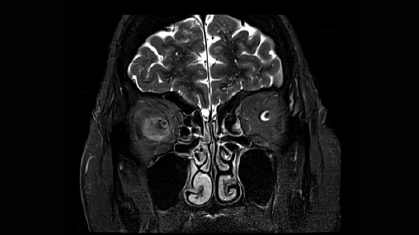 CT image of retro-ocular masses causing exophthalmos along with bilateral perinephric, pericardial, and pelvic exudates