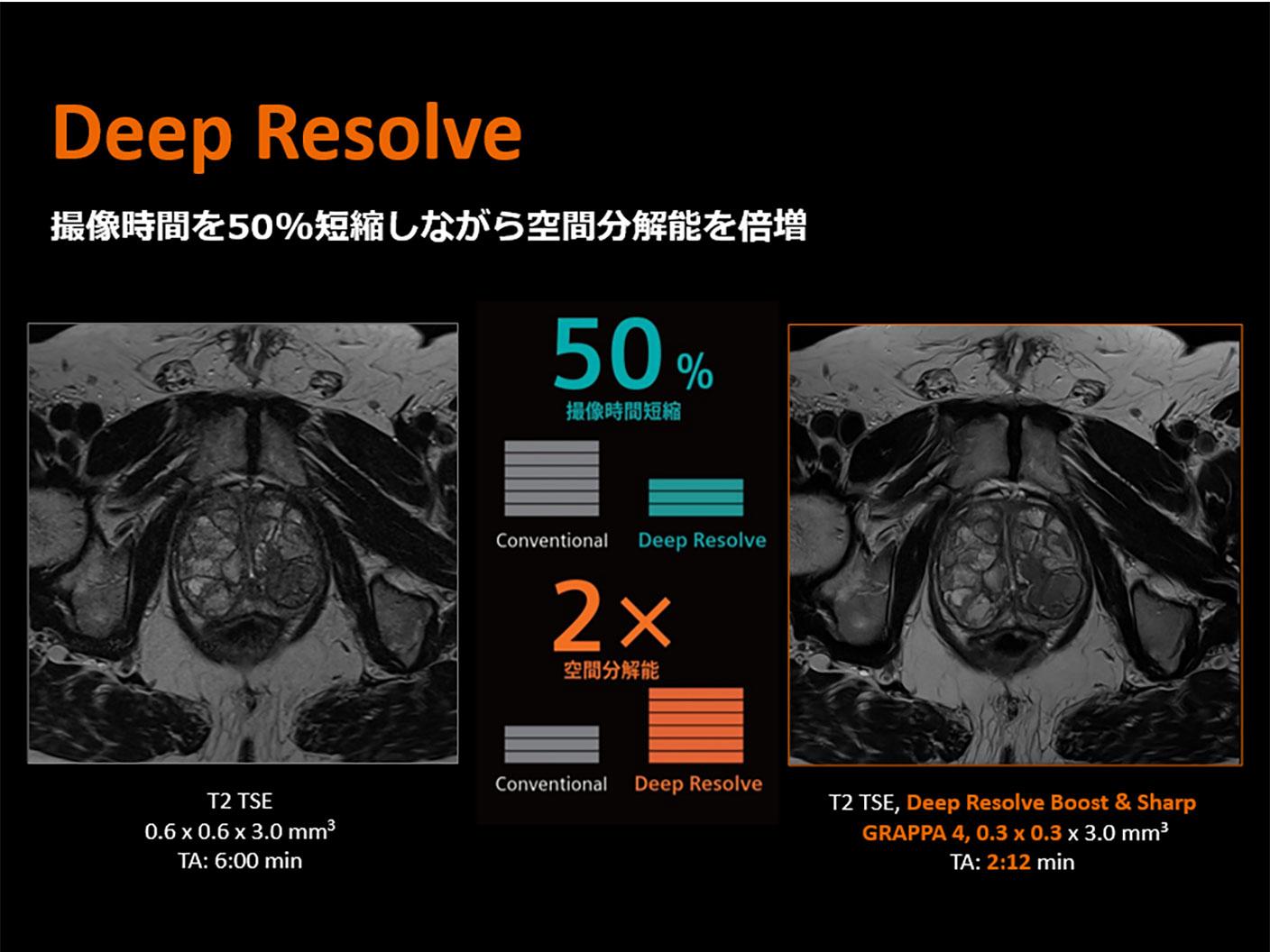 Deep Resolve 撮像時間を50%短縮しながら空間分解能を倍増