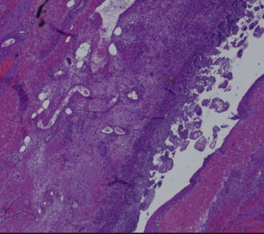 Fig. 15: Small bowel wall with ischemic necrosis (Hematoxylin & Eosin, 4X)