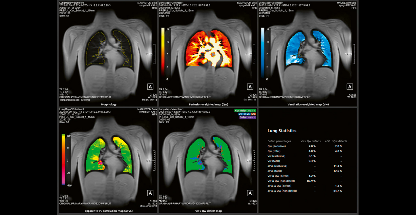 Siemens.healthineers_Magnetomworld_lungsmaps