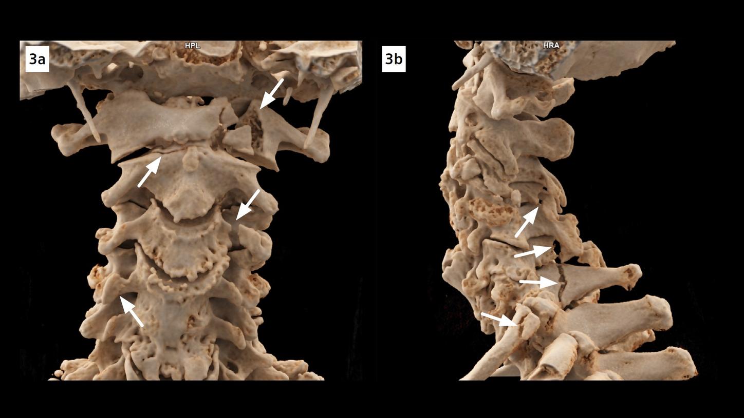 cVRT images show fractures of the C1, C2 dens, foramina transversaria of the C3 and the C4, spinous processes of the C4 and C6, bilateral arcus of the C7 and the head of the first rib on the left.