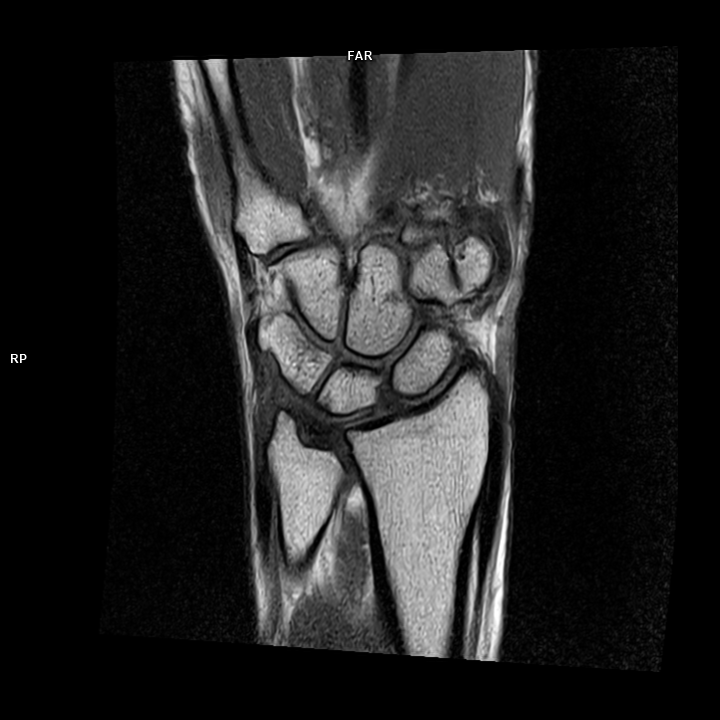 Coronal T1-MAGNETOM Free.Max/Coil-Contour Small/Resolution-640/Scan Time-3:30/Aceleration-DRS