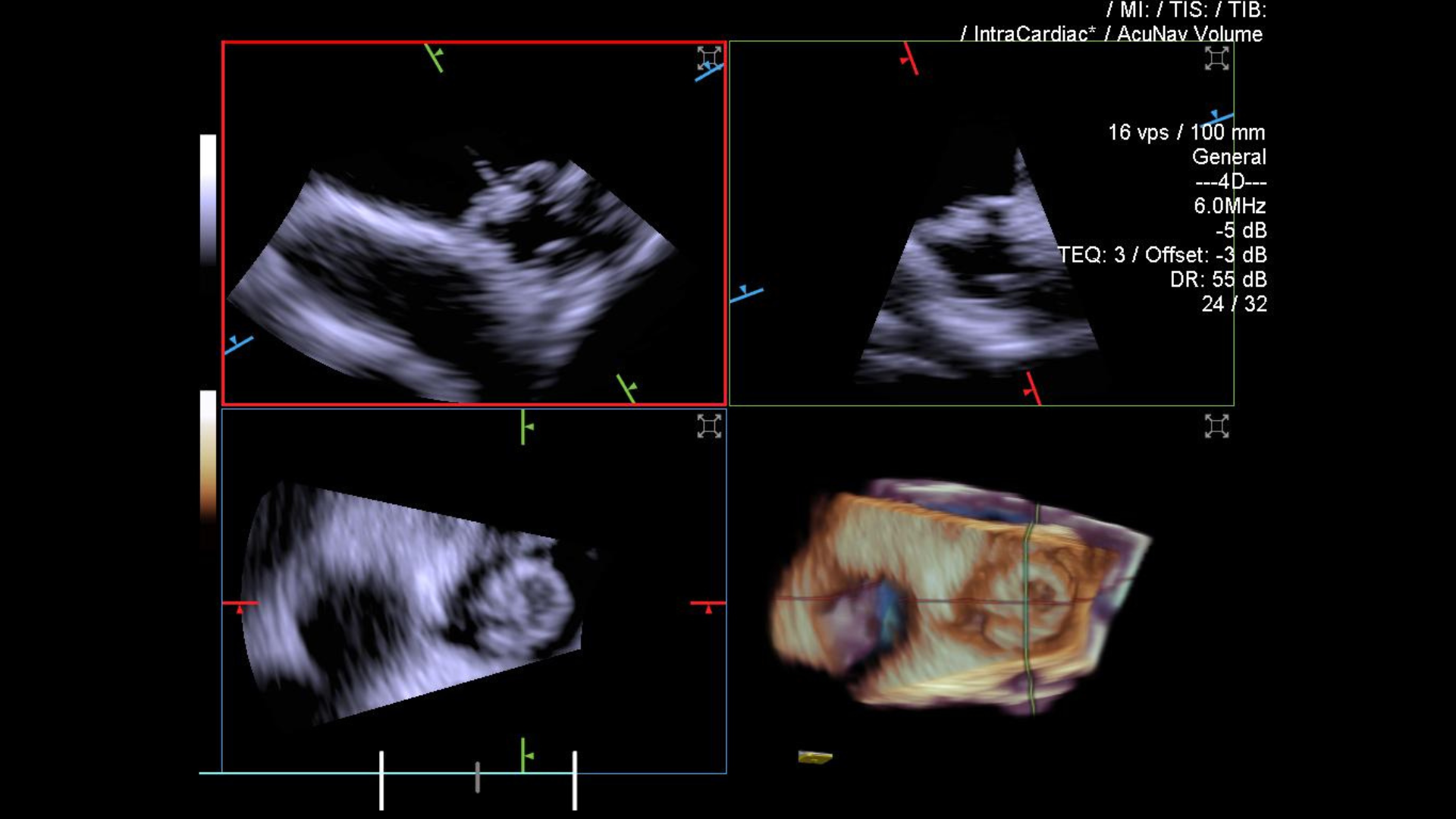 ACUSON AcuNav Volume ICE Catheter Siemens Healthineers Vietnam