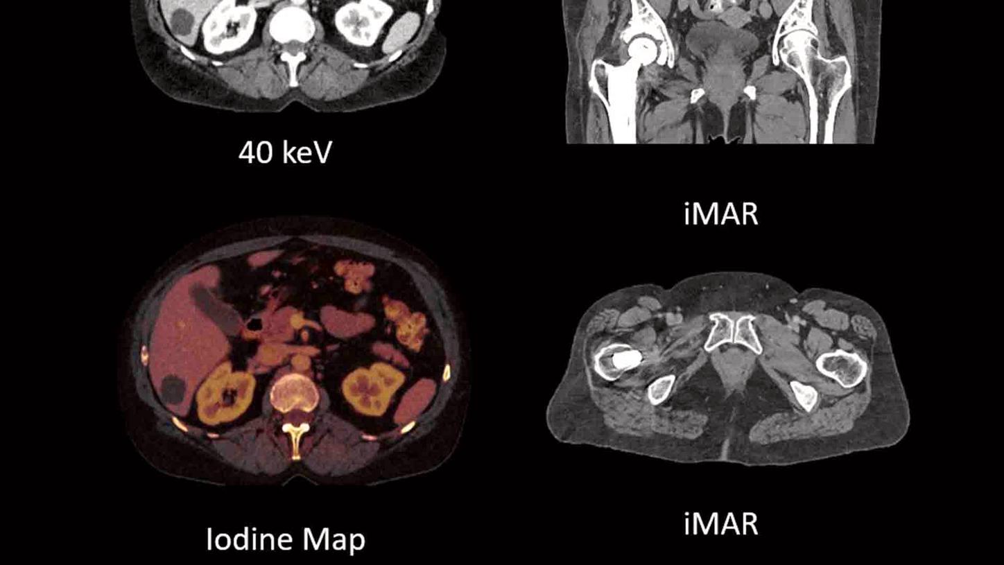 Dual Energy: TwinBeam vs. TwinSpiral