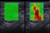 Image F: Elastography images also suggest a stiff mass.