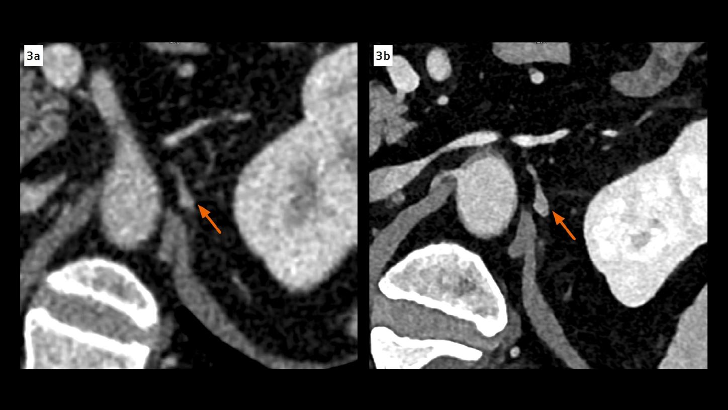 Axial EID and PCT CT images. Thickening and enhancement of the left celiac ganglion, not shown in an EID CT image, is clearly seen in a PCD CT image, indicating a metastasis. It is also confirmed by pathological analysis after surgery. Both images are displayed at same window settings. Note the improved contrast in the PCD CT image using a VMI displayed at 50 keV.
