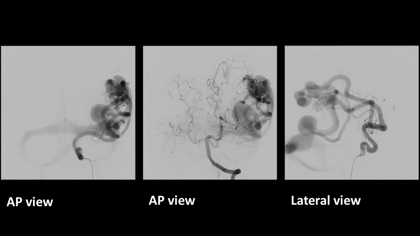 Cerebral Arterio-venous malformation pediatric case