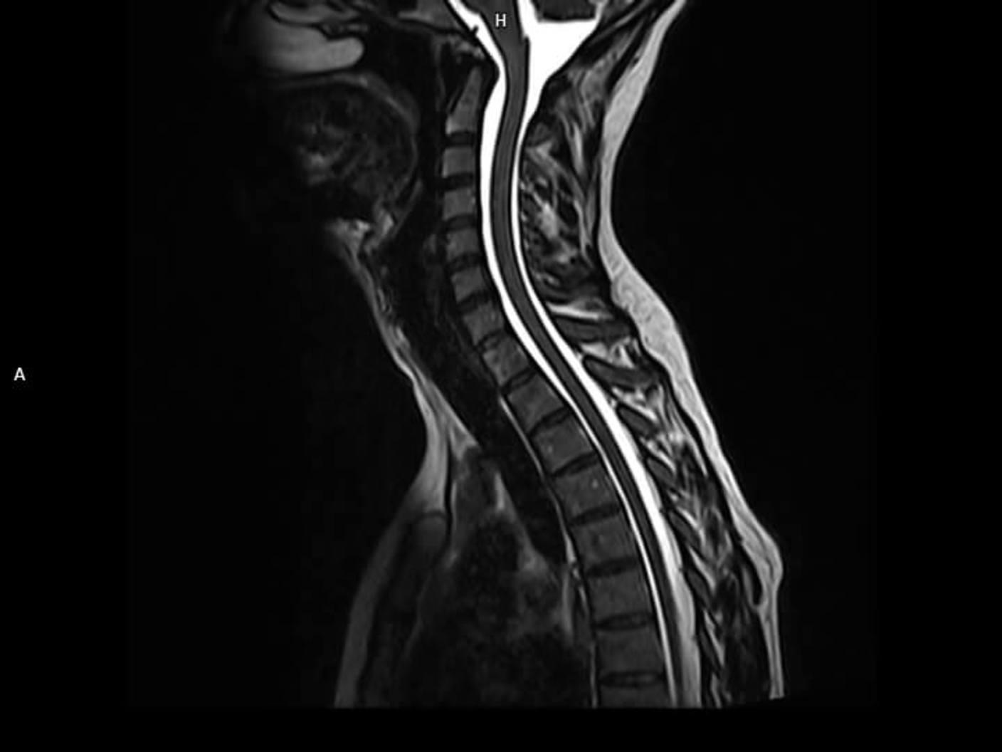 Sagittal T2 3D SPACE-MAGNETOM Altea