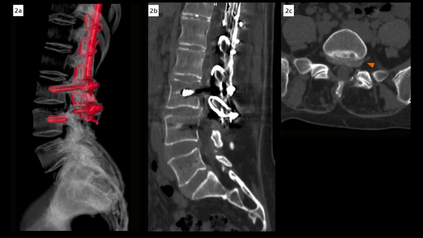 Three lumbar spine CT images demonstrating L5–S1 disc pathology. A volume rendering reconstruction showing the posterior fixation hardware with evidence of screw fracture at the L4 level. Sagittal and axial reconstructions with iterative metal artifact reduction and 140 keV images demonstrate subarticular and left foraminal protrusion of the L5–S1 disc, partially occupying the left lateral recess and compressing the exiting nerve root, consistent with type D L5–S1 foraminal impingement. 