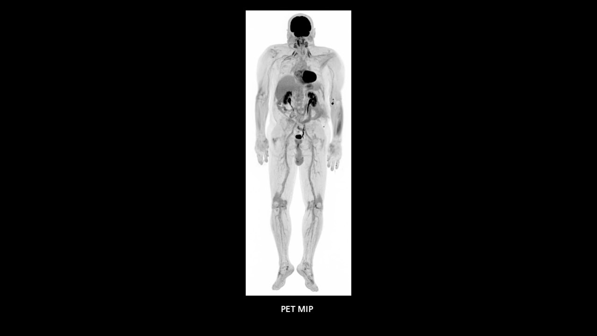 Biograph Vision Quadra News & Stories - Siemens Healthineers