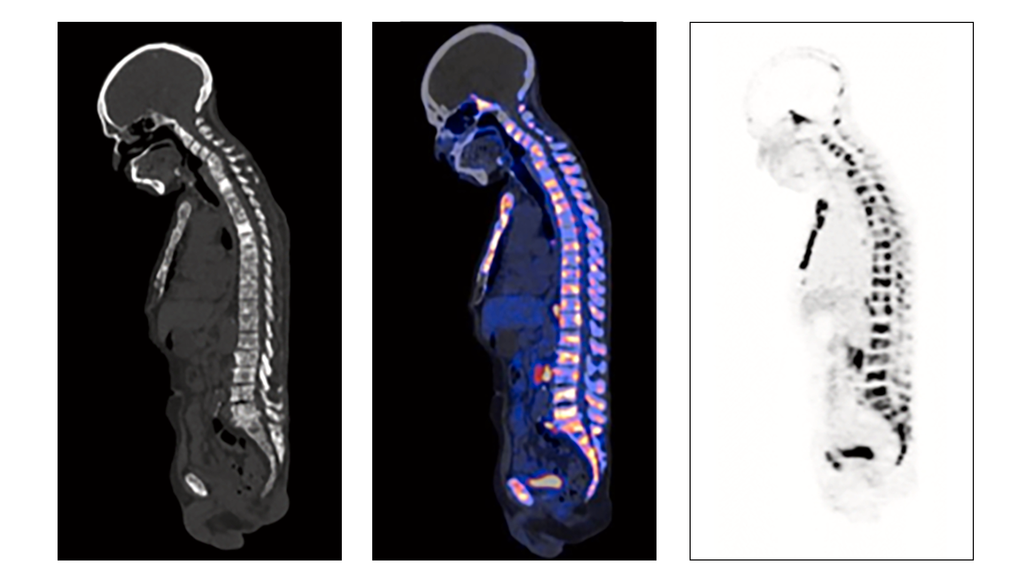 A patient’s experience: Theranostics offers personalized care for ...