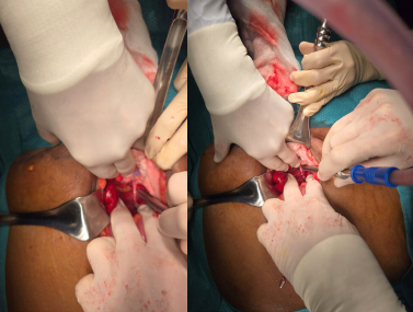 Fig. 13: Intraoperative image illustrating the pelvic fibrous band responsible for causing small bowel obstruc-
