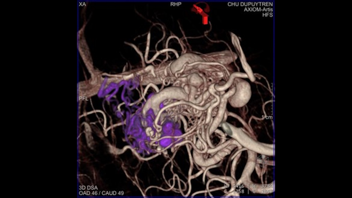 AVM Neurointerventions Mounayer