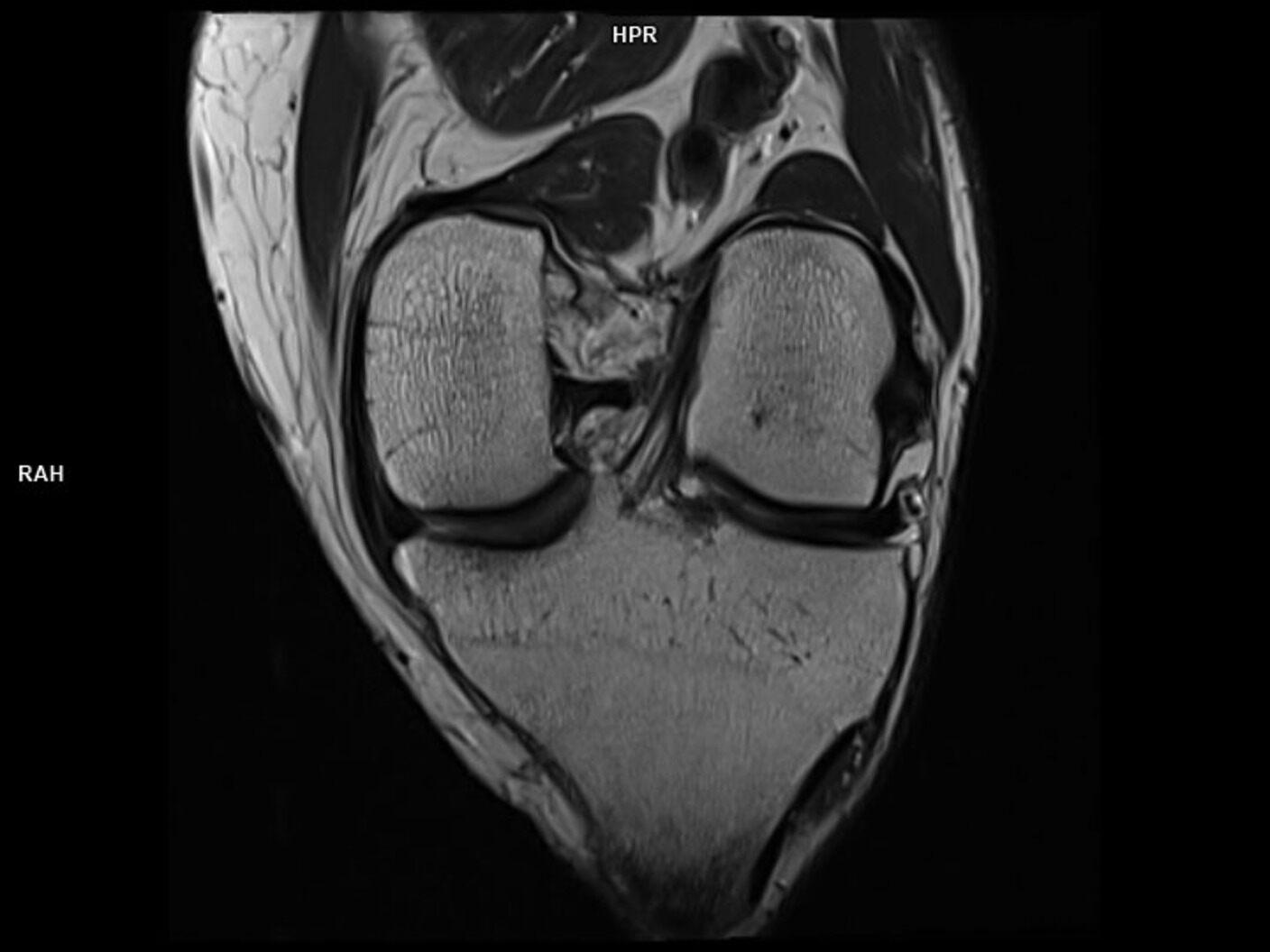 Coronal T2 TSE-MAGNETOM Lumina