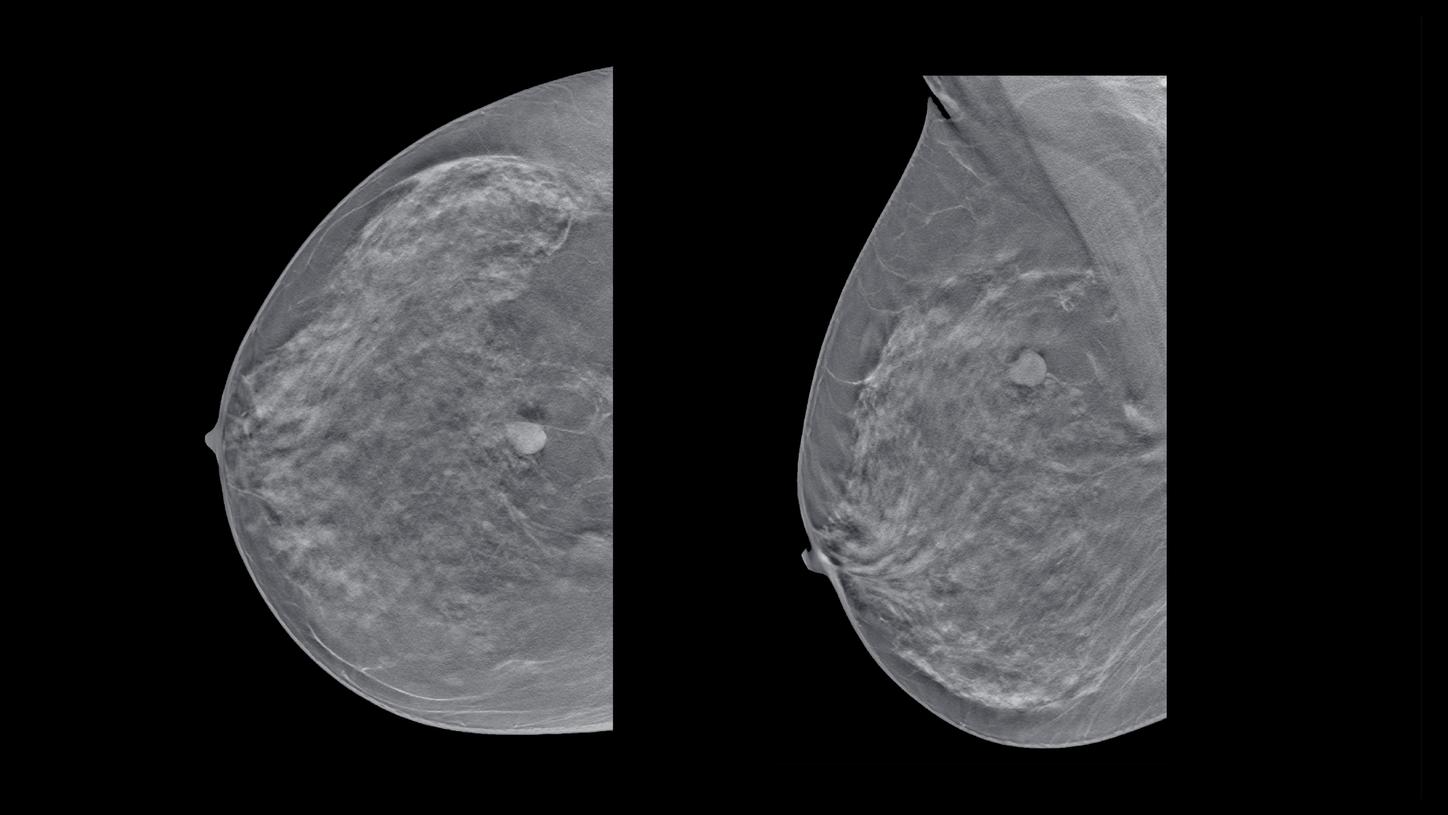 PET MIP images show metastases vertex to thighs and help differentiate normal liver and 68Ga DOTATATE-avid metastases