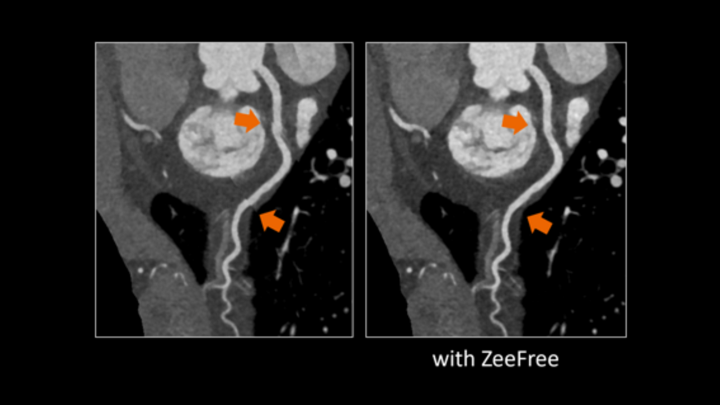 Cardiac ZeeFree comparison