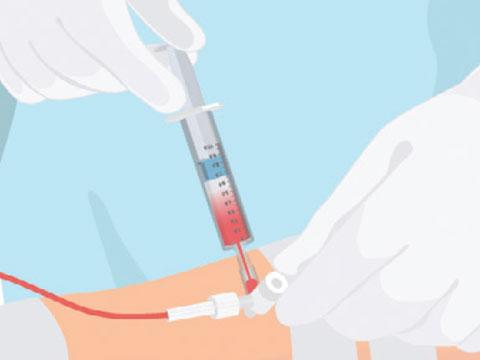 血液ガス分析かわら版②採血