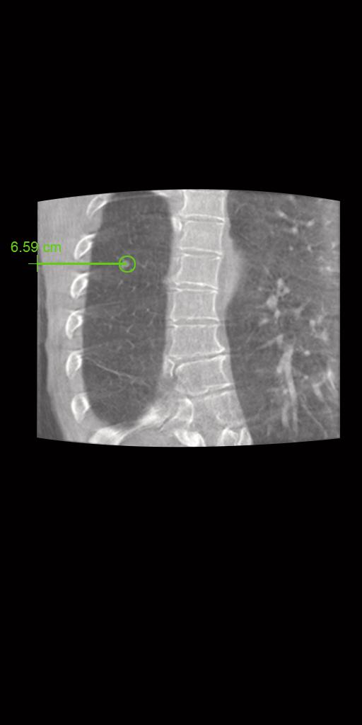 Clinical image of needle-path planning for RF ablation of lung nodule
