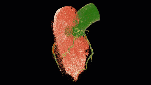 clinical_proof_2_heart_ct