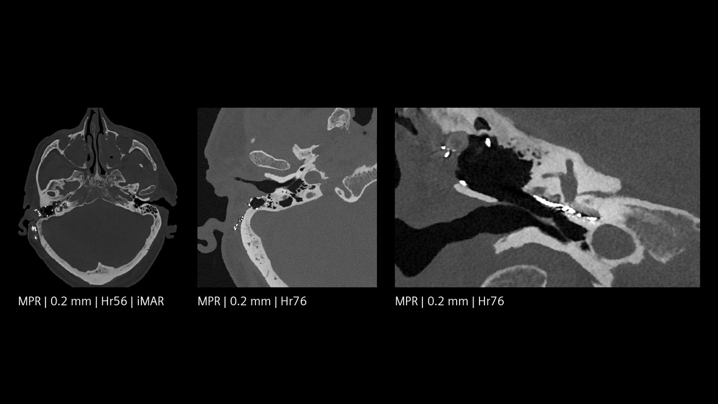 High-resolution CT images of the temporal bone showing middle ear implants in multiple planes.