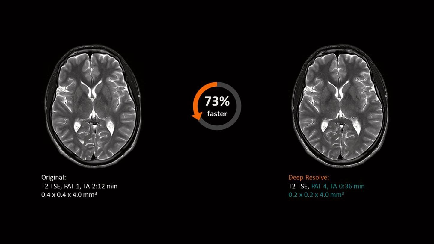 Boost your MR acquisition speed in neuro imaging